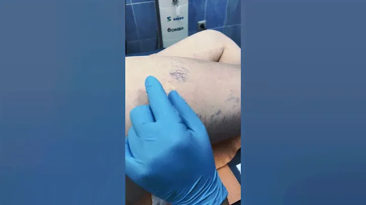 СКЛЕРОТЕРАПИЯ В МЦ SANTE