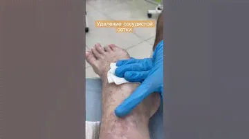 Удаление сосудистой сетки на ногах. Склеротерапия. Флеболог Москва