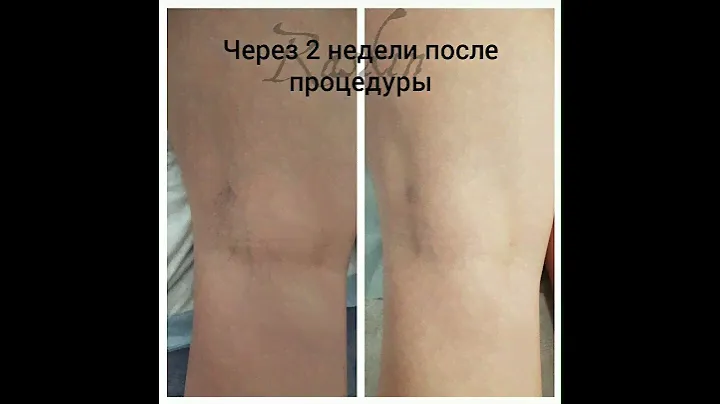 Удаление сосудистой "звездочки" методом склеротерапии. Лечение проводит врач-флеболог Раскин В.В.