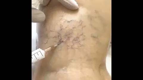 склеротерапия